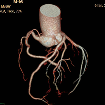 Yizhun CACIPS冠狀動(dòng)脈CT影像處理軟件