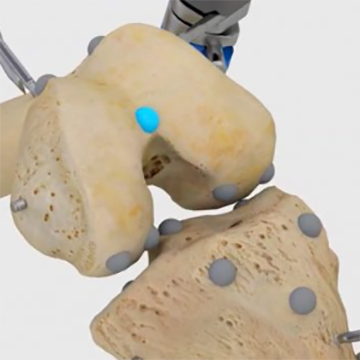 膝關節(jié)置換手術導航系統(tǒng)surgical navigation system