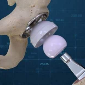 人工髖關節(jié)g7 acetabular system