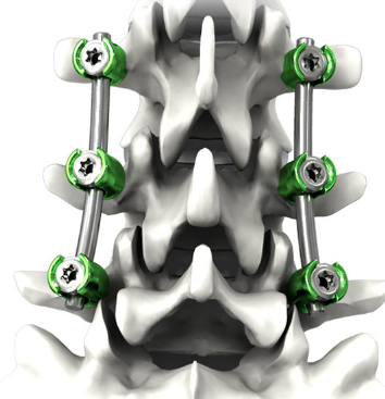 胸腰椎后路釘棒內固定系統(tǒng)大博