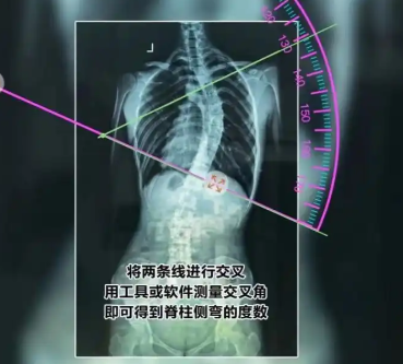 脊柱側彎輔助測量軟件gd-ais