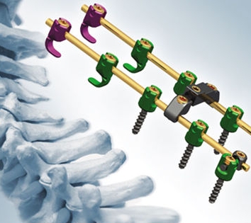 斯潘威椎板固定板系統