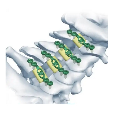 正天椎板固定板系統(tǒng)