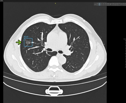 肺結節ct影像輔助分診軟件