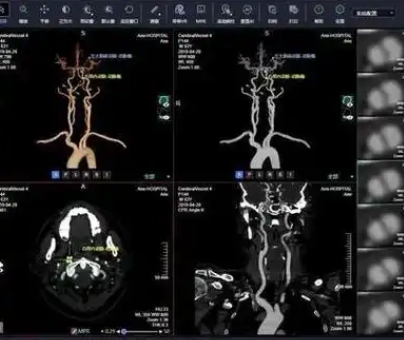 顱內(nèi)動(dòng)脈瘤ct造影圖像輔助檢測(cè)軟件