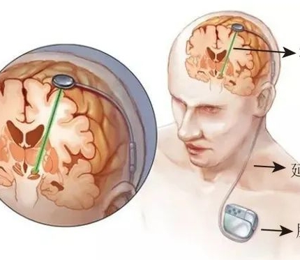 雙通道可充電植入式腦深部電刺激脈沖發生器套件