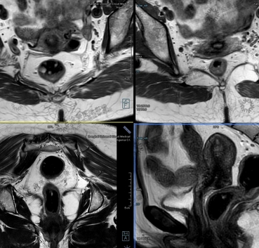 直腸mri醫(yī)學(xué)影像存儲(chǔ)傳輸與處理軟件